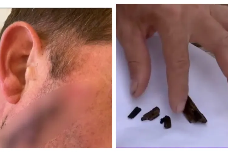 Caz revoltător într-un spital! Un bărbat susține că a fost cusut cu o așchie de lemn în obraz și trimis acasă. Ce s-a întâmplat după câteva săptămâni