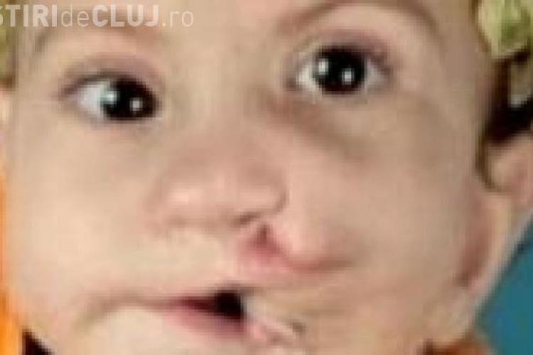 Fetita cu doua guri operata de medici din SUA VIDEO