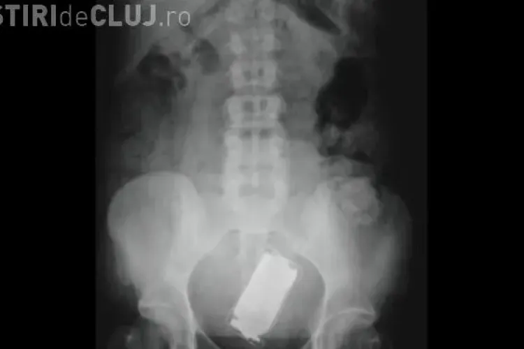 Ce si-a introdus acest pacient in anus si i-a socat pe medici?