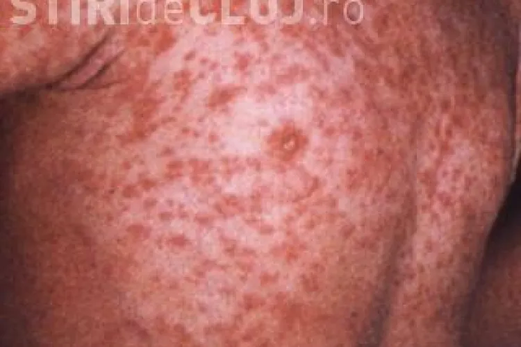 Alerta! Epidemie de rujeola la Cluj