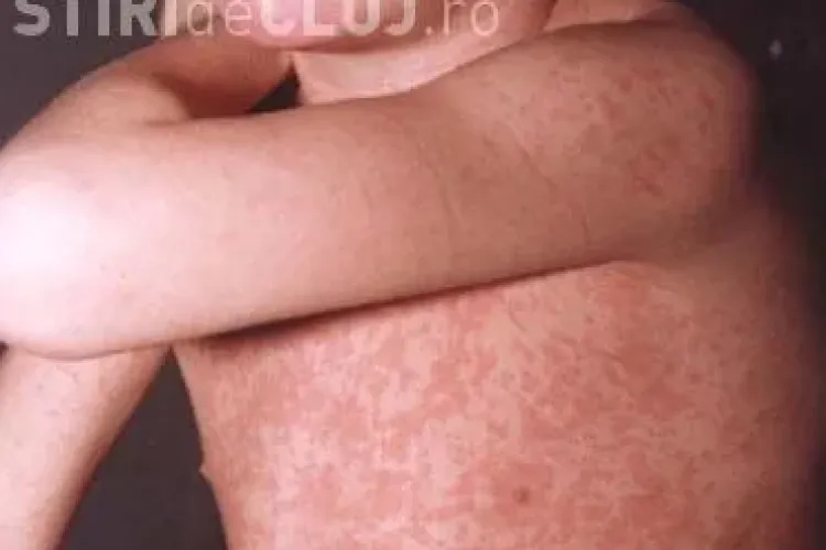 Epidemie de rubeola la Cluj! Cei mai afectati sunt baietii si barbatii
