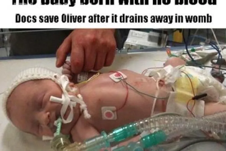 Un bebelus s-a nascut fara o picatura de sange in corp si a supravietuit!
