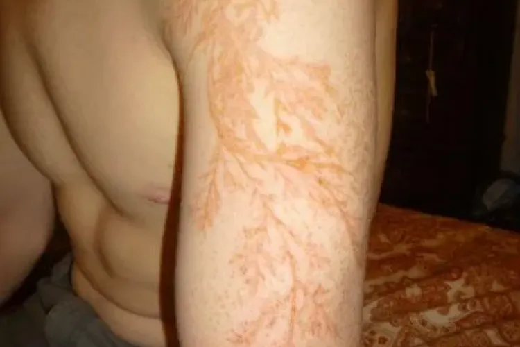 S-a ales cu un tatuaj pe mana dupa ce a fost traznit de un fulger! FOTO