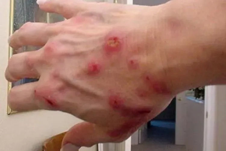 Atentie! MAI-IUNIE, sezonul instens de activitate a capuselor. Cum sa te feresti