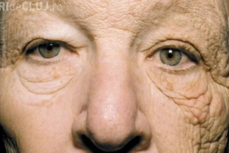 Care este efectul SOCANT al razelor soarelui asupra pielii! Vezi cum a imbatranit un sofer de TIR pe jumatate de fata