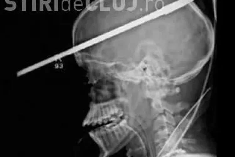 A supraviețuit, după ce o suliță i-a străpuns creierul! Poveste INCREDIBILĂ