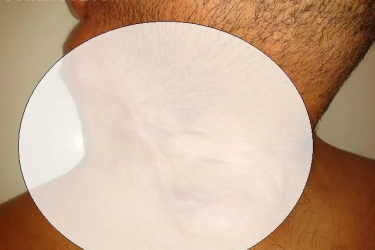 Un clujean de 30 de ani, diagnosticat cu o tumoră extrem de rară, ne cere AJUTORUL