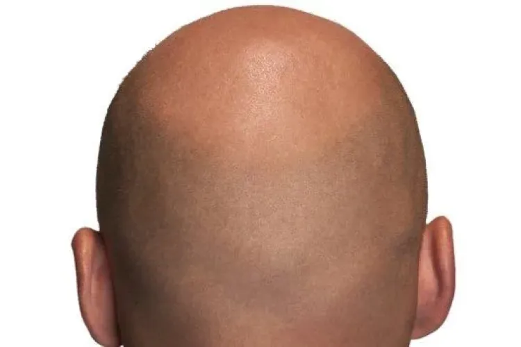 Soluție INEDITĂ pentru bărbații cu chelie FOTO