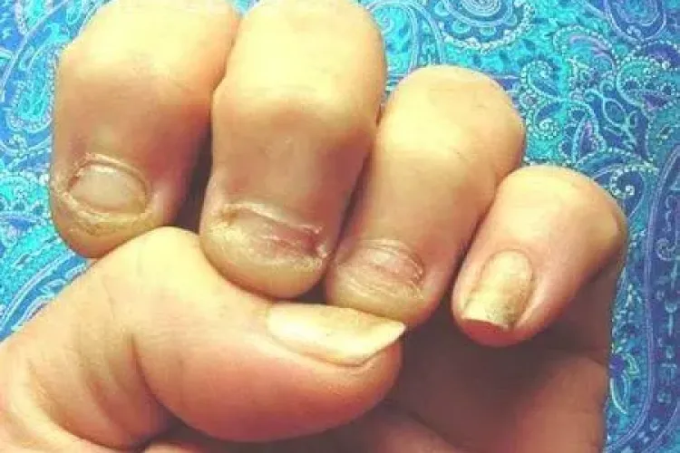 Cât de grav este dacă vă roadeți unghiile! Citește opinia psihiatrilor