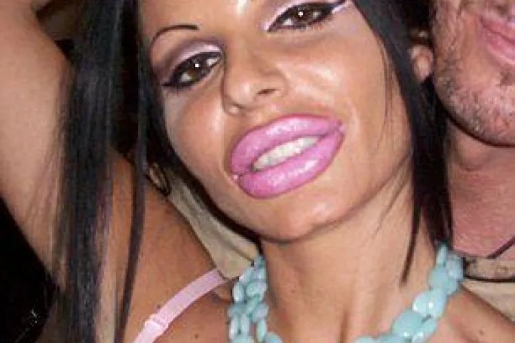 Și-a mărit buzele până când și-a distrus viața - FOTO