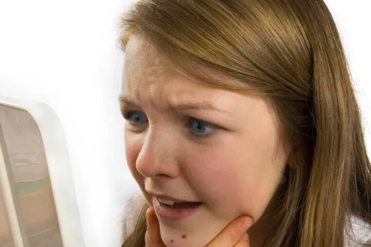 Adevărul despre alimentele care provoacă acneea. Vezi explicația cercetătorilor