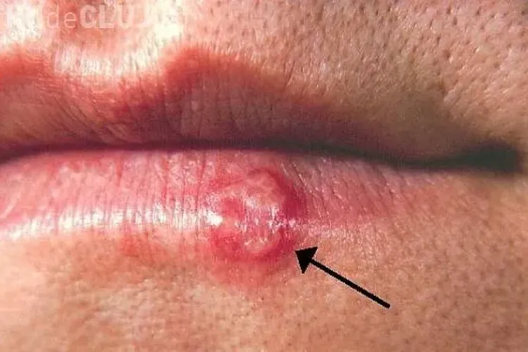Ai avut herpes? Vezi ce riscuri sunt asociate cu acest virus