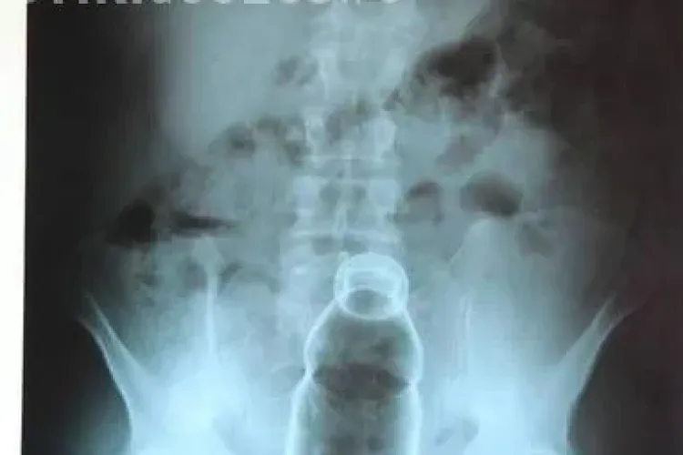 I-a uimit pe medicii de la Urgență. Avea o sticlă de suc în anus - Radiografie ȘOC