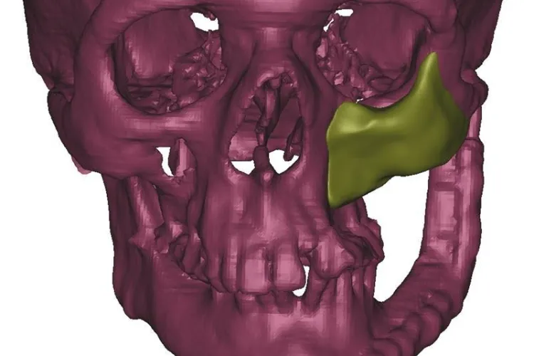 Chirurgii clujeni i-au refăcut fața unui pacient din TITAN. Operația e o PREMIERĂ - VEZI FOTO