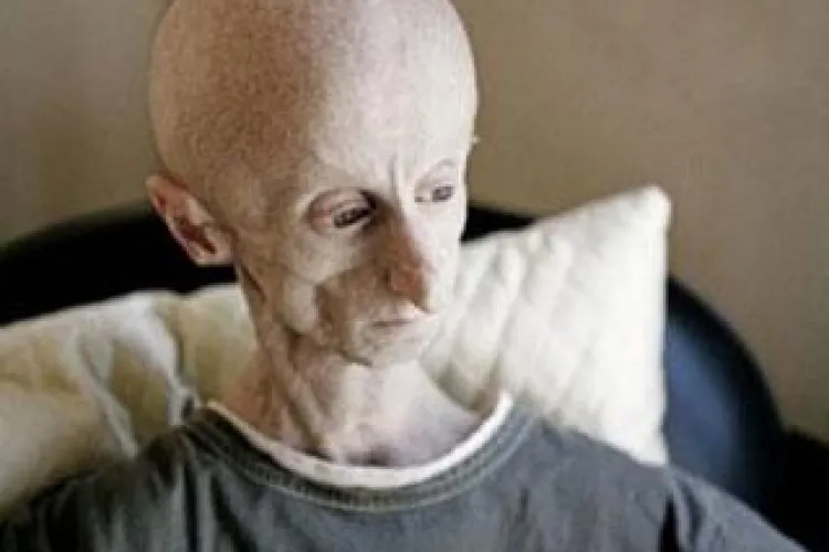 FOTO - Omul-Extraterestru locuieste in Africa! Barbatul sufera de o boala rara si este DJ!