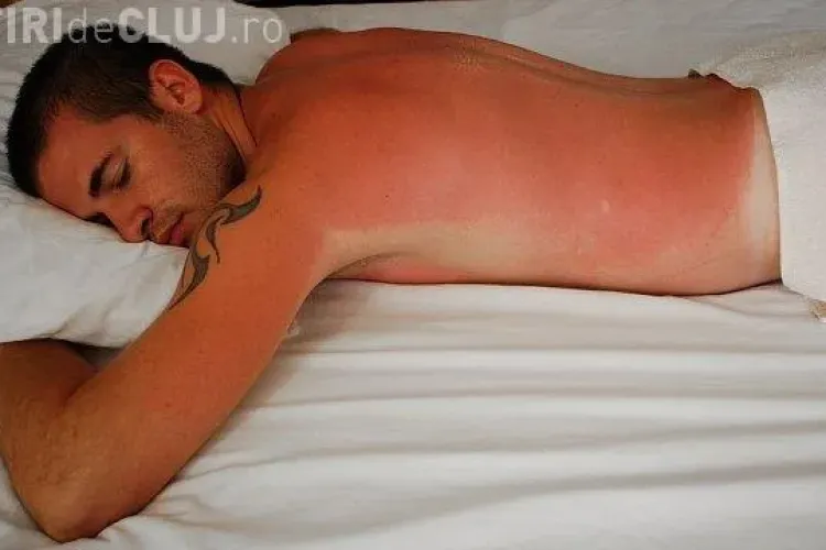 Cum să tratezi cel mai bine arsurile solare