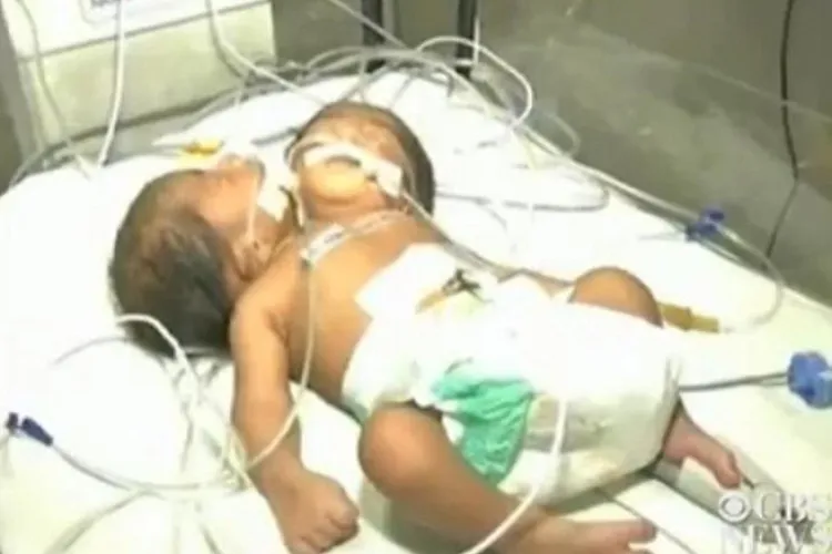 Bebeluș născut cu două capete. Ce decizie au luat medicii - FOTO