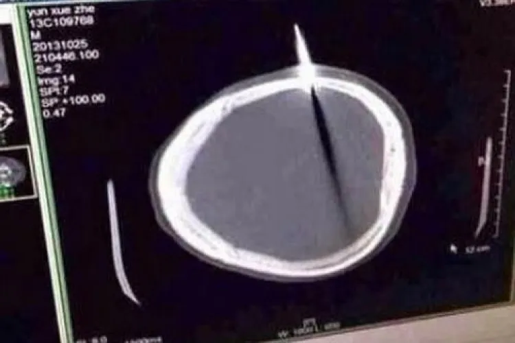 S-a prezentat la spital cu un cuţit înfipt în cap. Medicii au fost uimişi - FOTO viral pe internet