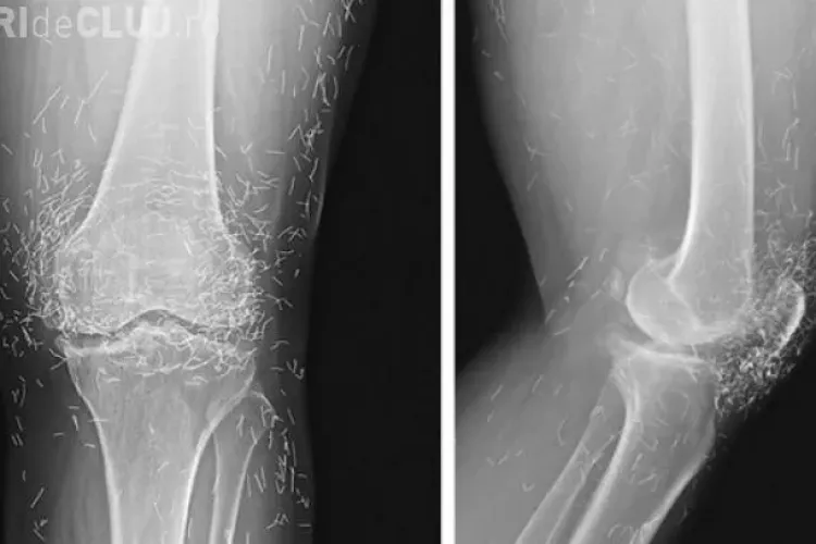 Femeia cu genunchii de aur. Medicii s-au crucit - FOTO