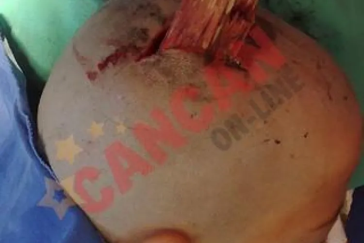 Un copil din Bihor a supravietuit cu o bucata de lemn infipta in cap - Imagini socante!