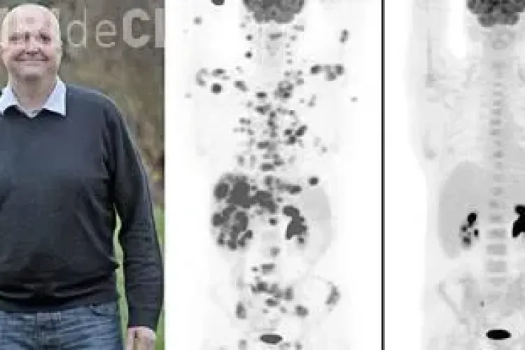 Vindecare miraculoasă de cancer a unui bărbat în 12 săptămâni. Care este tratamentul