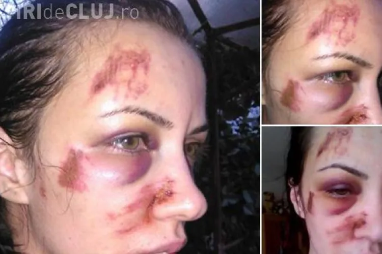 Româncă bătută crunt de fostul iubit. Ce răspuns a primit de la Poliție