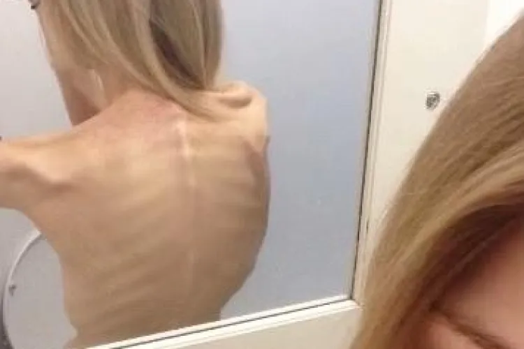 S-a înfometat pentru a arăta mai bine și a ajuns intr-un punct DRAMATIC - VIDEO